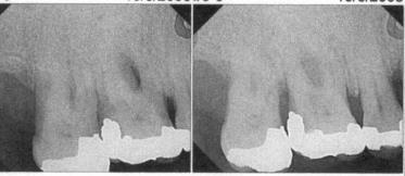 Occlusal Trauma Root Fracture #14 TREATMENT PLAN Occlusal
