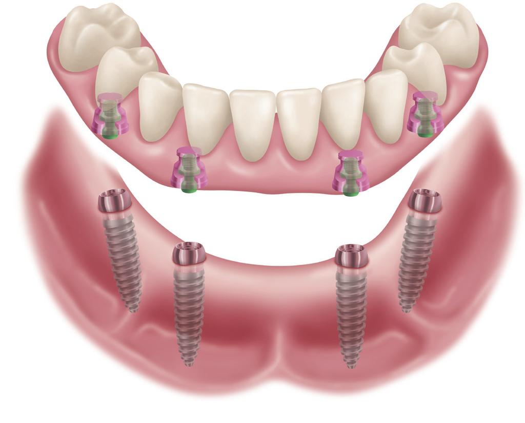LOCATOR F-Tx A NEW WAY TO THINK ABOUT FIXED FULL-ARCH RESTORATIONS.