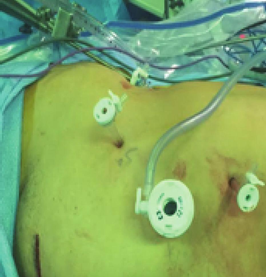 During the procedure, the surgeon removes one kidney from the donor.