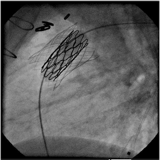 Case example - TPVR Melody Melody valve implant then done as stent