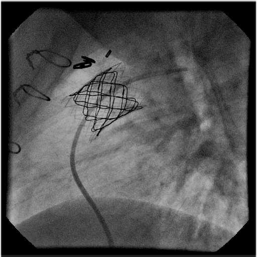 Case example - TPVR Melody Pulmonary angiogram postvalve: no