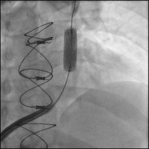Case example - TPVR Edwards Sapien XT Stenting first with
