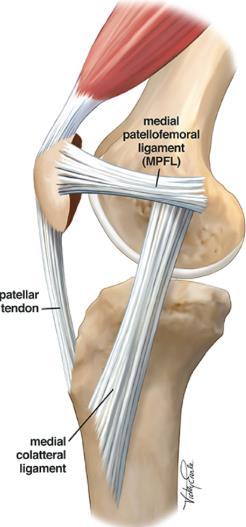 Knee MPFL Reconstruction FAQ Ryan W. Hess, MD Office: 763-302-2223 Fax: 763-302-2402 Twitter: RyanHessMD Q: WHAT IS ACCOMPLISHED DURING THE PROCEDURE? MPFL stands for Medial Patellofemoral Ligament.