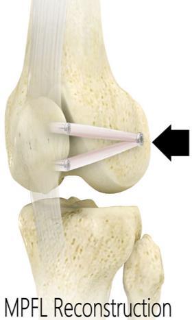 The new ligament is secured in these locations. Q: HOW DOES THE SURGEON SEE AND PERFORM WORK IN THE KNEE? Surgeons use a small camera (called an arthroscope) and small tools to work inside the knee.