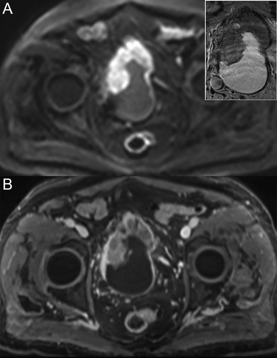 73. Urinary Bladder and Male Pelvis Urinary bladder carcinoma is best locally staged with MRI.