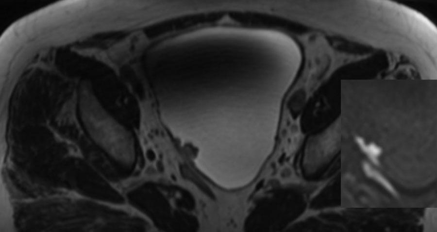 the bladder wall due to urinary excretion of the administered gadolinium chelate. Cystitis enhances similarly, as opposed to the late enhancement seen with wall fibrosis.