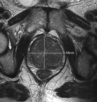 T2 Weighted Imaging T2WI is captured using FSE in the three orthogonal planes (axial, sagittal, coronal) typically resulting in excellent T2 contrast for the depiction of zonal anatomy, including the