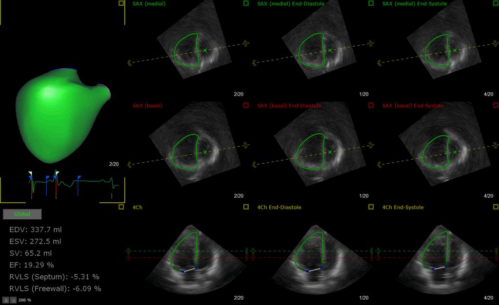 3D Echocardiographic Evaluation of Right Ventricular Function and Strain: a Prognostic Study in Paediatric