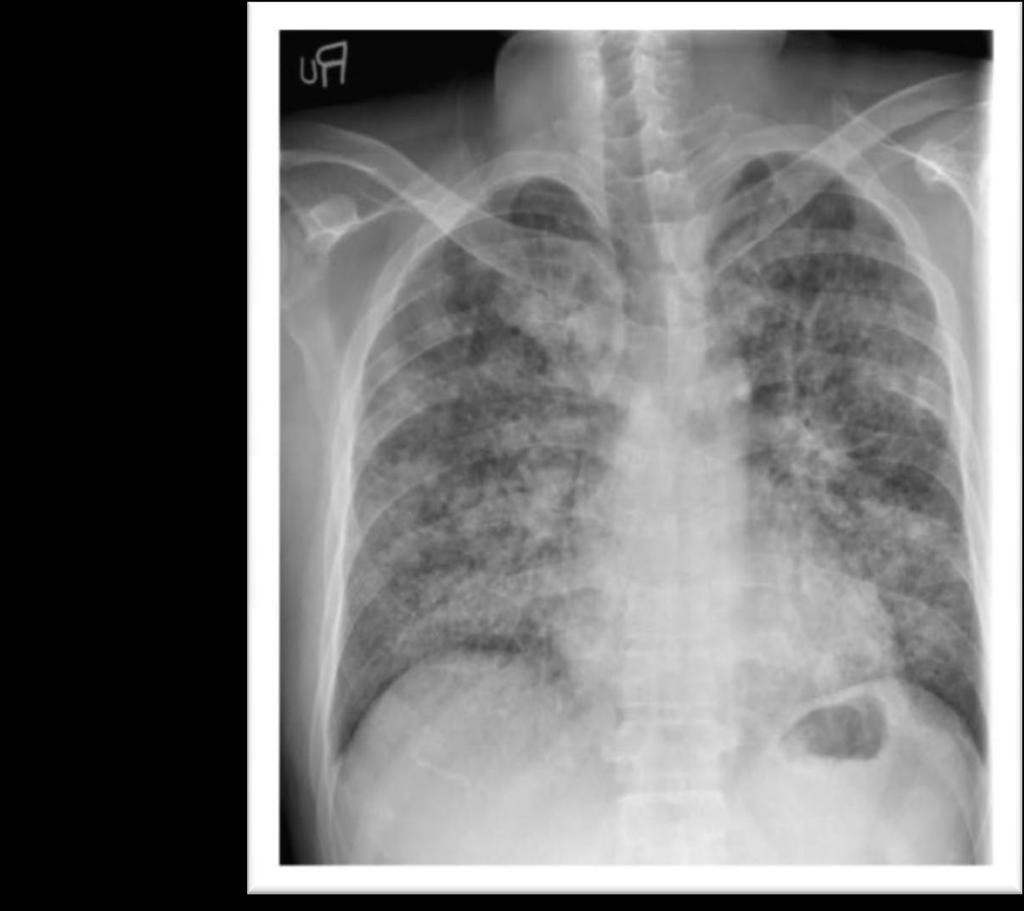 criteria to diagnose ARDS Chest X-ray (CXR) and arterial blood gas analysis are required to make the