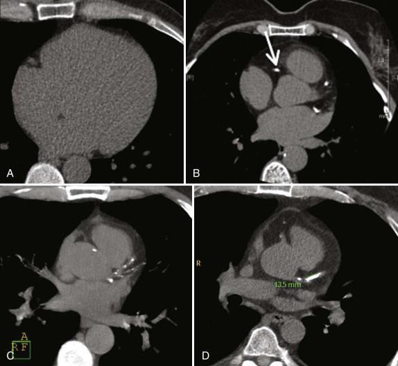Cardiac CT Coronary Artery Calcium Scanning Non-contrast study Refine clinically predicted risk of CHD beyond that predicted by standard cardiac risk