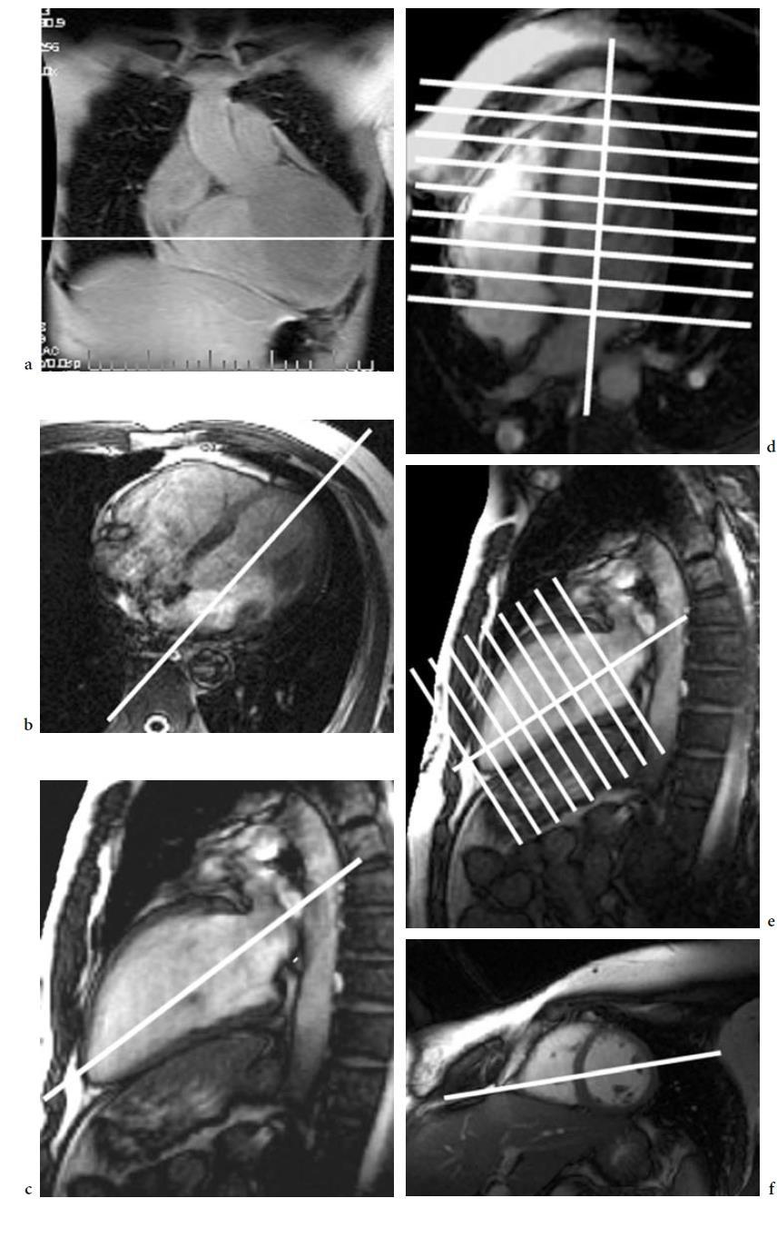(a) Coronal scout; (b) enddiastolic image in axial projection; (c) end-diastolic image on long vertical axis; (d) end-diastolic image on long horizontal axis; (e) end-diastolic image on long vertical