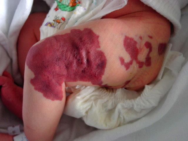 Vascular Anomaly Diagnosis Most often a clinical diagnosis http://www.adhb.govt.nz/newborn/teachingresources/dermatology/vascularlesions.