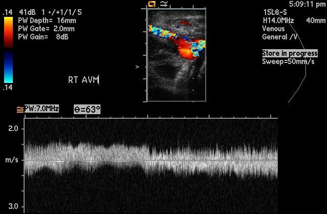 Arteriovenous Malformation 12 week old female right scapular AVM Spectral