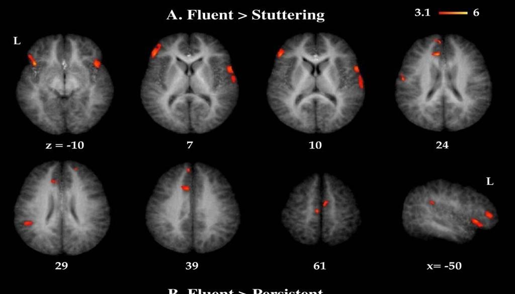 Structural imaging in CWS Group differences in Gray Matter Fluent > Stuttering inferior, middle,