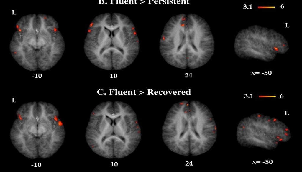 supramarginal g. Recovered > Persistent posterior cingulate cerebellar inferior frontal g.