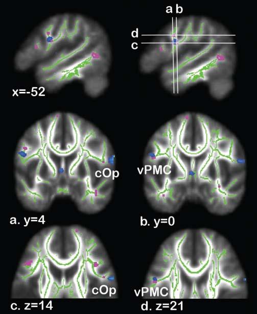 Structural imaging associated with neural activation? Fig. 3 Structural and functional abnormalities in the premotor cortex and underlying white matter in people who stutter.