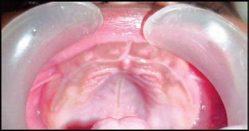 Mandible is distal to the maxilla in class II pattren and usually the upper jaw overlap the lower jaw in anterior