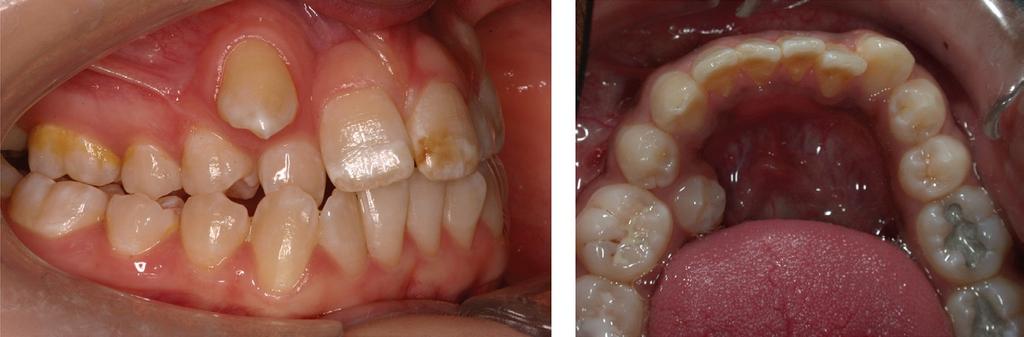 Crowding of the maxillary canine (left panel) and mandibular second premolar (right panel). The UR3 is buccally crowded due to timing of eruption; the LL5 is crowded due to early loss of the LLE.