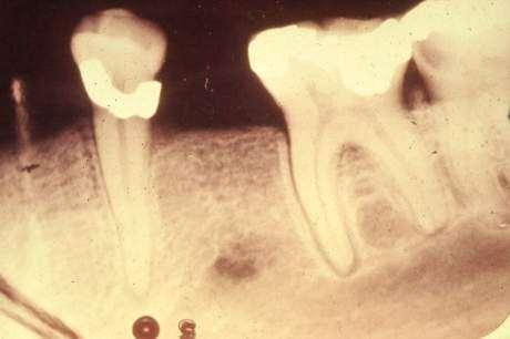 Radiograph of lower Molar with Traumatic Occlusion.