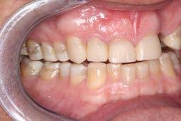 protect the anterior teeth from overload This is the goal with natural teeth and with implants Group Function Mutually Protected Occlusion Lateral