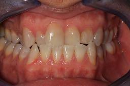 Occlusion Occlusion is the relationship between all the components of the masticatory system both in acceptable function and not.