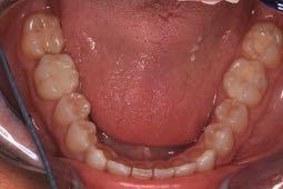 Functional Occlusion? Occlusal Disease In the past occlusion was taught as a rigid dogma.