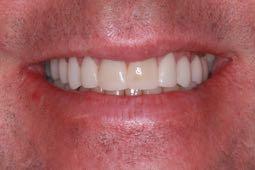 Anterior Constriction This occurs when the anterior teeth are in the way, ( the first point of contact is on the anterior teeth) causing them to hit when chewing, forcing the jaw posterior to CR.