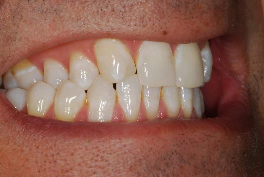CANINE TEETH WHICH ARE IN THE POSITON OF