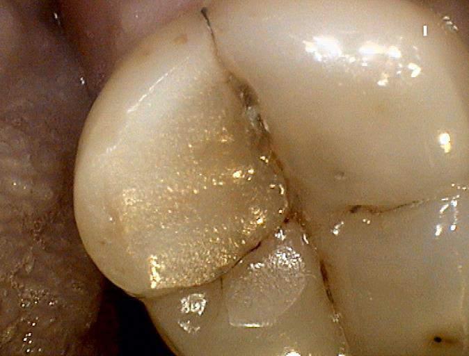 FORCES ON POSTERIOR TEETH IN NORMAL FUNCTION