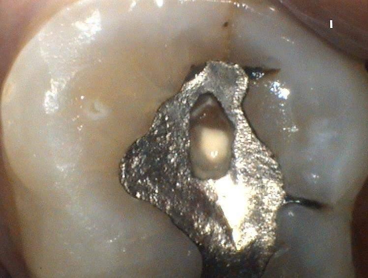 A TYPICAL PICTURE IN BRUXERS WITH LITTLE ANTERIOR GUIDANCE. APART FROM THE OBVIOUS FRACTURES, THERE IS ALSO A WORN AMALGAM.