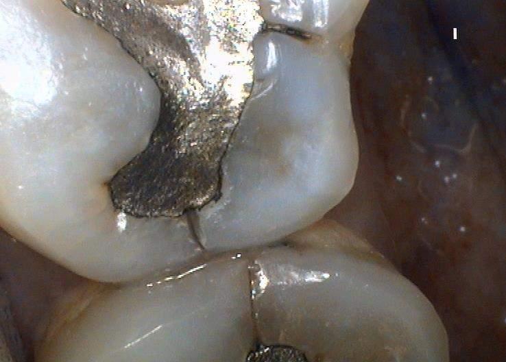 HEALTHY TOOTH TISSUE REMOVED) TO GIVE AN ADEQUATE THICKNESS OF RESTORATIVE MATERIAL.