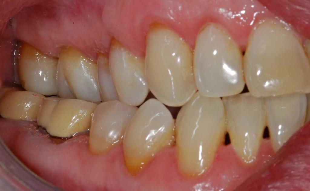 THE ONLY VIABLE TREATMENT WAS ADJUSTMENT OF THE CROWN. THE UPPER BUCCAL CUSP COULD NOT BE REDUCED AS IT WAS THE HOLDING CUSP IN A CROSSBITE.