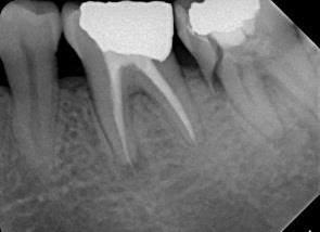 TEETH UNDERGOING ROOT CANAL THERAPY SHOULD