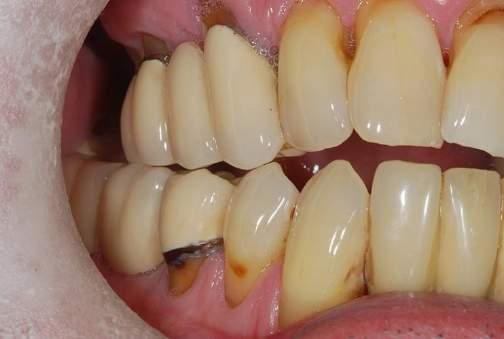 FULL ARCH IMPLANT CASES SHOULD ALSO