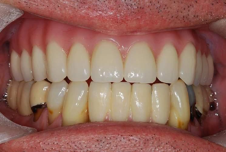 TRIAL RUNNING THE FULL DENTURE PRIOR TO IMPLANT PLACEMENT ENSURES THAT THE PATIENT IS BOTH