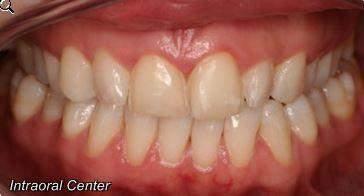 BEFORE AND AFTER ORTHODONTIC CASE WHICH