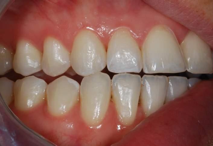 IN THE FINISHED CASE, THERE IS A PARTIAL LOSS OF CANINE GUIDANCE IN LATERAL EXCURSION WITH VERY HEAVY CONTACT ON THE LATERAL INCISOR AND