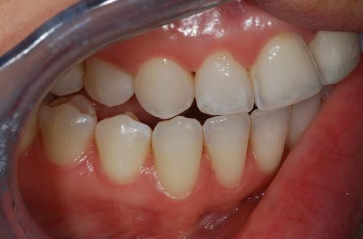 THE PATIENT FEELS THAT THE LATERAL INCISOR SEEMS BRUISED AND UNCOMFORTABLE ALL THE TIME.