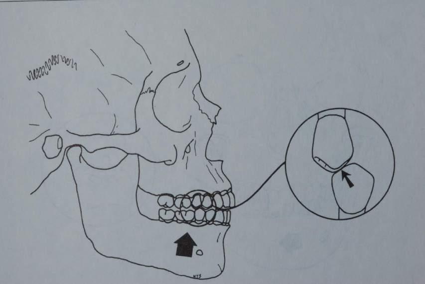 CENTRIC PREMATURITIES A centric occlusal interference often occurs during mandibular closure between maxillary mesial-facing cusp inclines and mandibular