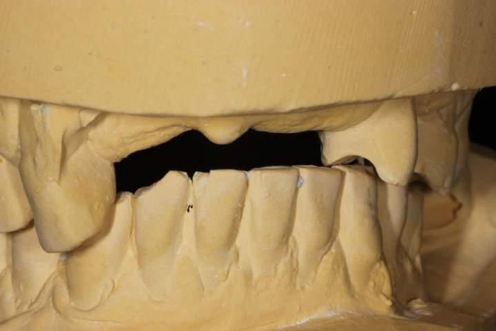 THE CLINICAL OCCLUSAL PICTURE IS CONFIRMED BY FACEBOW MOUNTING STUDY MODELS