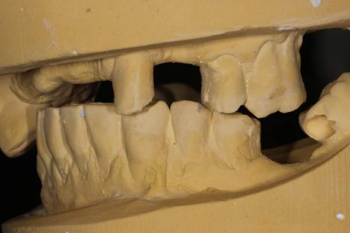 RESTORATIONS HAVE TO BE PROVIDED IN THIS CENTRIC OCCLUSAL RELATIONSHIP NOT