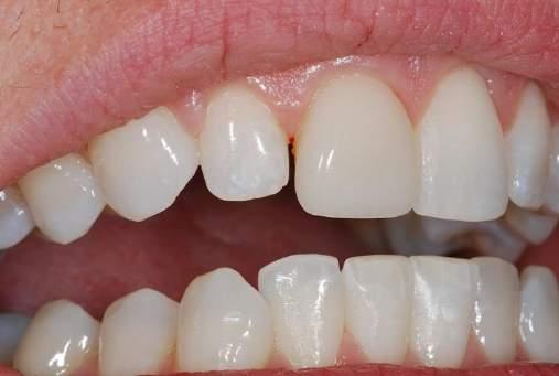 A DIASTEMA THAT APPEARED IN A MATTER