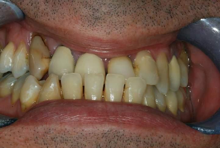 SIMPLY RE-ARRANGING THE OCCLUSION CAN LEAD TO SPONTANEOUS RESOLUTION OF TOOTH MAL-ALIGNMENT THE