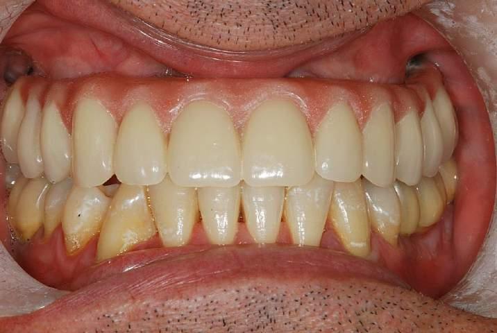 ESTABLISHMENT OF A NORMAL CLASS 1 ANTERIOR RELATIONSHIP THE LOWER ANTERIOR TEETH RE-ALIGNED