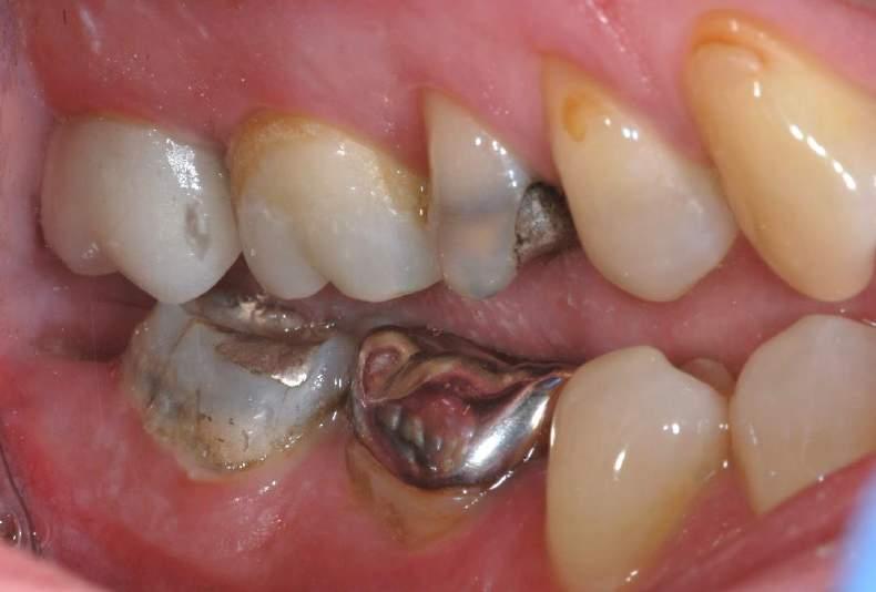 THE BUCCAL CUSPS ARE TOO LONG AND PRODUCE INTERFERENCES IN BOTH