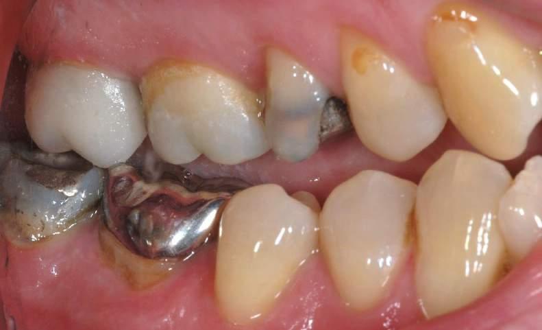 REASON FOR FRACTURE OF THE BUCCAL CUSPS AND NEED FOR A CROWN LOOK