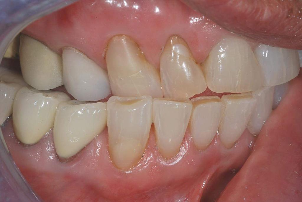 LINGUAL CUSP HEIGHT OF BOTH PREMOLARS ADJUSTED TO BRING