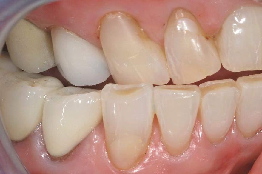 BEFORE AND AFTER OCCLUSAL ADJUSTMENT BY REDUCTION