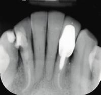The slow super-eruption of the lower incisors was followed by super eruption of the alveolar bone, resulting in maintenance of the bone