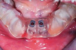 Integrated treatment workflow Implant site preparation and implant insertion Immediately after tooth extraction, two